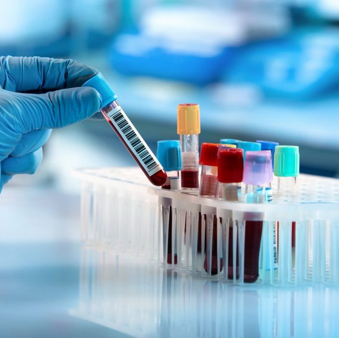Una mano guantata regge una provetta contenente sangue, accanto a diverse altre provette in un laboratorio clinico